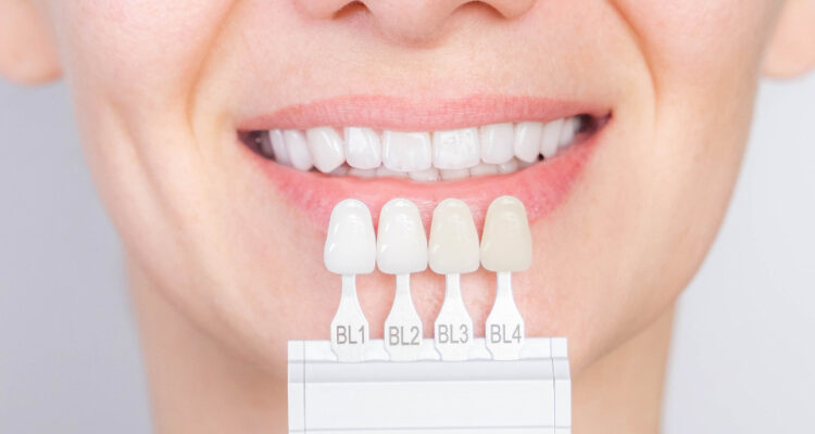 Was sind Veneers und welche Arten gibt es?