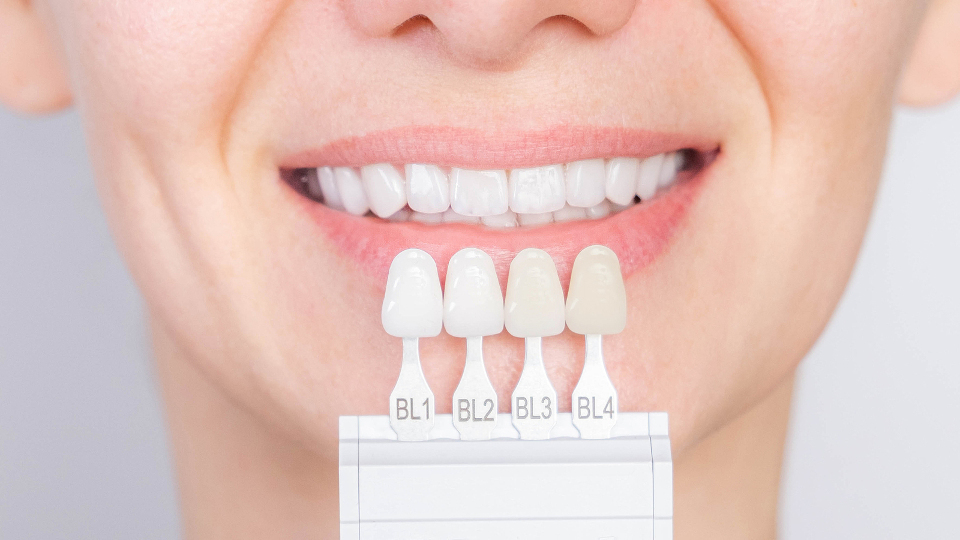 Was sind Veneers und welche Arten gibt es?
